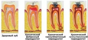 Механизм развития и классификация периодонтита временных и постоянных зубов
